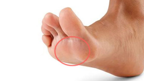 ball-of-foot-pain